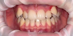 Прикус зубов 2