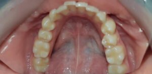 Прикус зубов 3