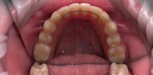 Прикус зубов 4